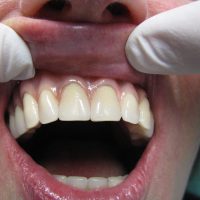 Home implantologia riabilitazioni full arch (1)