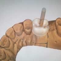 Home implantologia riabilitazioni full arch (10)