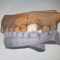 Home implantologia riabilitazioni full arch (12)