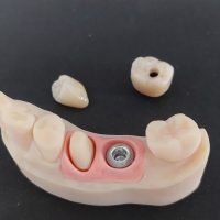 Home implantologia riabilitazioni full arch (13)