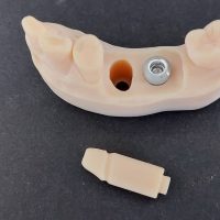 Home implantologia riabilitazioni full arch (14)