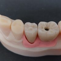 Home implantologia riabilitazioni full arch (15)