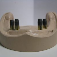 Home implantologia riabilitazioni full arch (17)