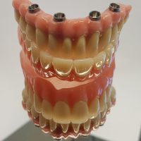 Home implantologia riabilitazioni full arch (2)