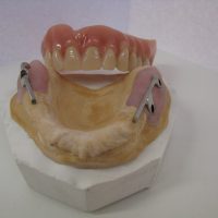 Home implantologia riabilitazioni full arch (21)