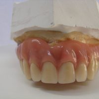 Home implantologia riabilitazioni full arch (22)