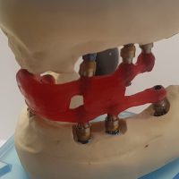 Home implantologia riabilitazioni full arch (4)