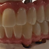Home implantologia riabilitazioni full arch (5)