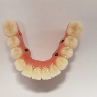 Home implantologia riabilitazioni full arch (7)