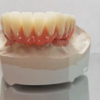 Home implantologia riabilitazioni full arch (8)