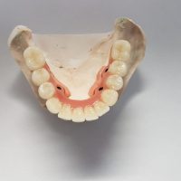 Home implantologia riabilitazioni full arch (9)