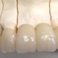 Home protesi fissa (1)