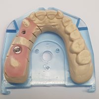 Home protesi fissa (10)