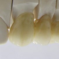 Home protesi fissa (13)