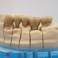 Home protesi fissa (2)