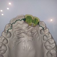 Home protesi fissa (3)