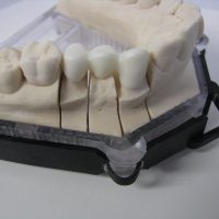 Home protesi fissa (6)