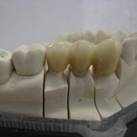 Home protesi fissa (8)