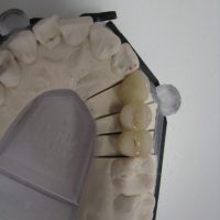 Home protesi fissa (9)