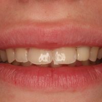 Home retainer digitali (4)